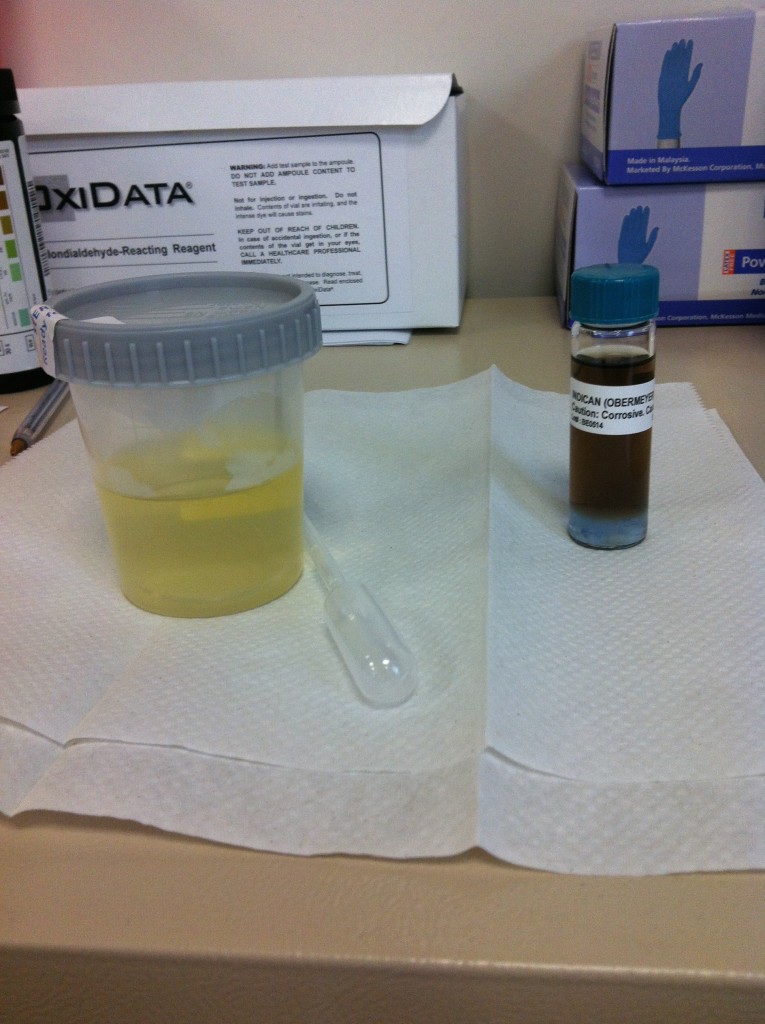 Urine Indican A Sensitive Test for Malabsorption Dr